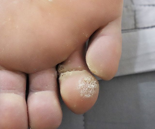 천안 사마귀 치료 경과 — 32세 남성 · 치료 전