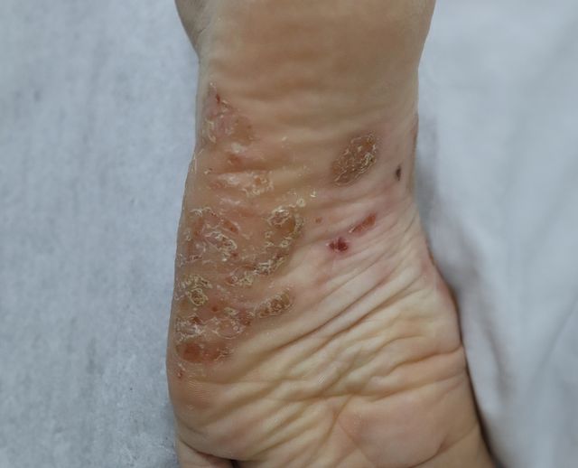 천안 한포진 치료 경과 — 27세 여성 · 치료 전