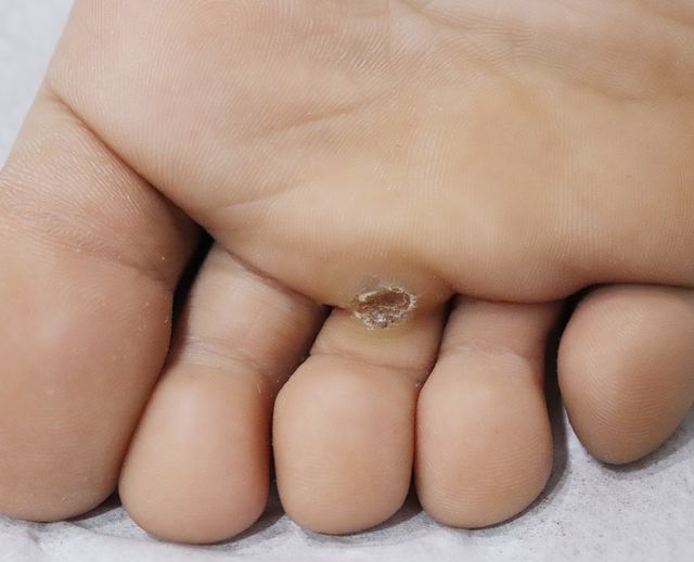 천안 사마귀 치료 경과 — 10대 남성 · 치료 전