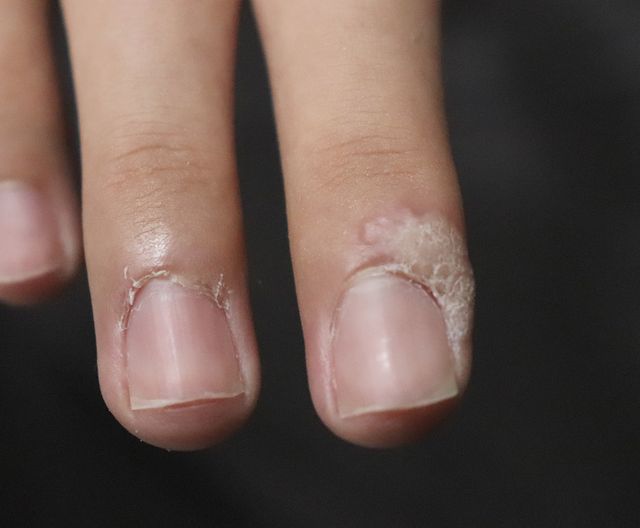 천안 사마귀 치료 경과 — 10대 남성 · 치료 전