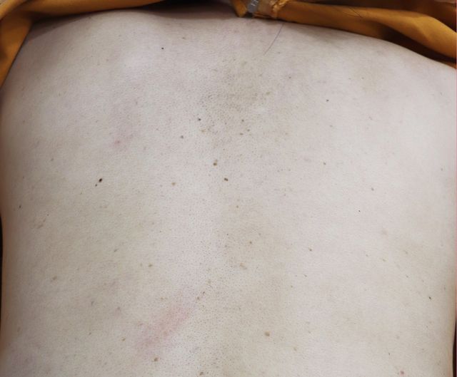 천안 사마귀 치료 경과 — 47세 여 · 치료 전