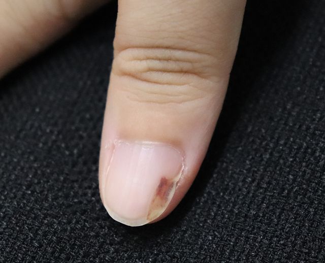 천안 사마귀 치료 경과 — 20대 여성 · 치료 전
