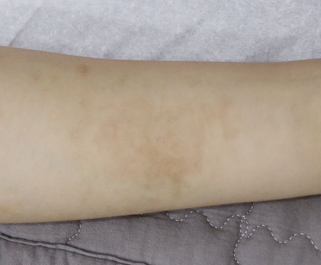 26세 여성 · 9개월 경과
