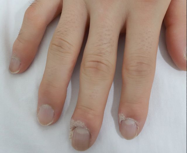 천안 사마귀 치료 경과 — 38세 남성 · 치료 전