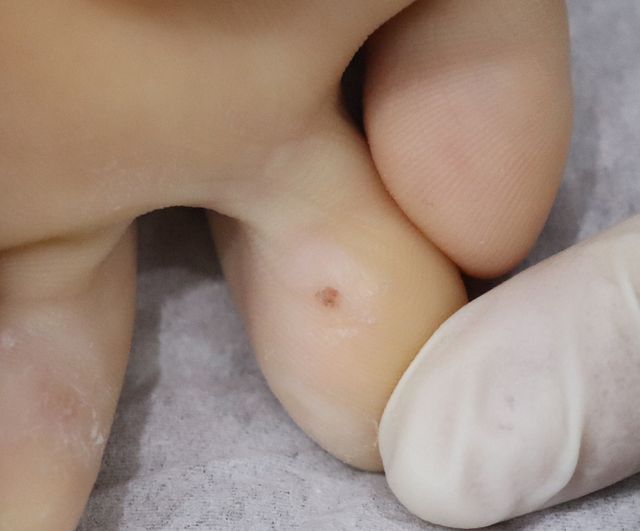 천안 사마귀 치료 경과 — 16세 여성 · 치료 전