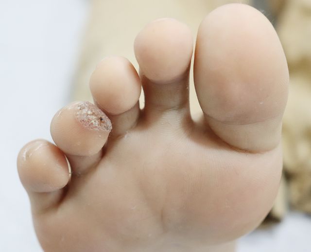 천안 사마귀 치료 경과 — 10대 남성 · 치료 전