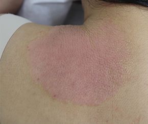 천안 건선 치료 경과 — 30대 여 · 치료 전