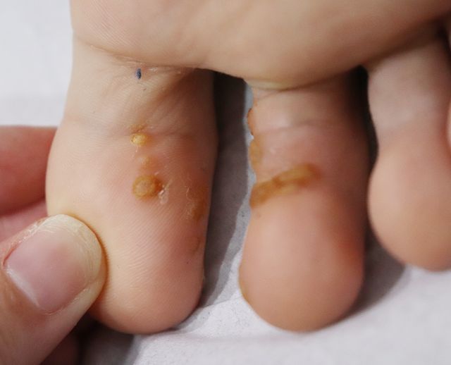 천안 사마귀 치료 경과 — 10대 남성 · 치료 전