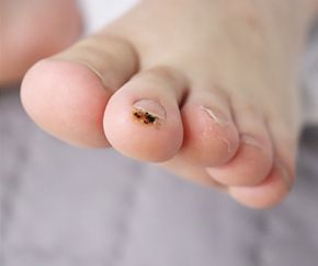 천안 사마귀 치료 경과 — 30대 남성 · 치료 전