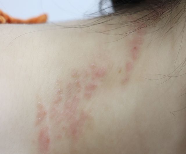 천안 아토피 치료 경과 — 25세 여성 · 치료 전